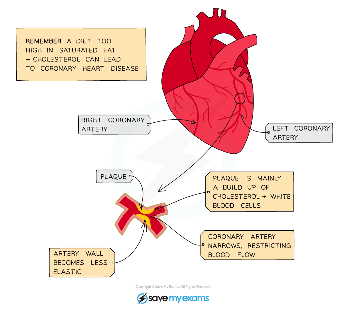 Buildup-of-plaque-in-the-coronary-arteries