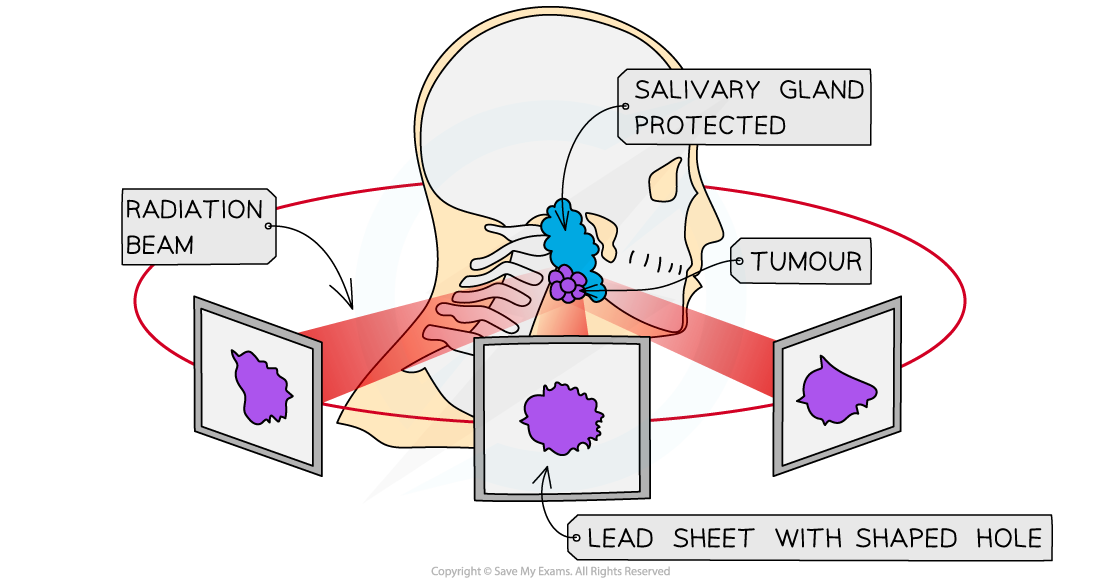 8.1.6-Radiation-Therapy-2