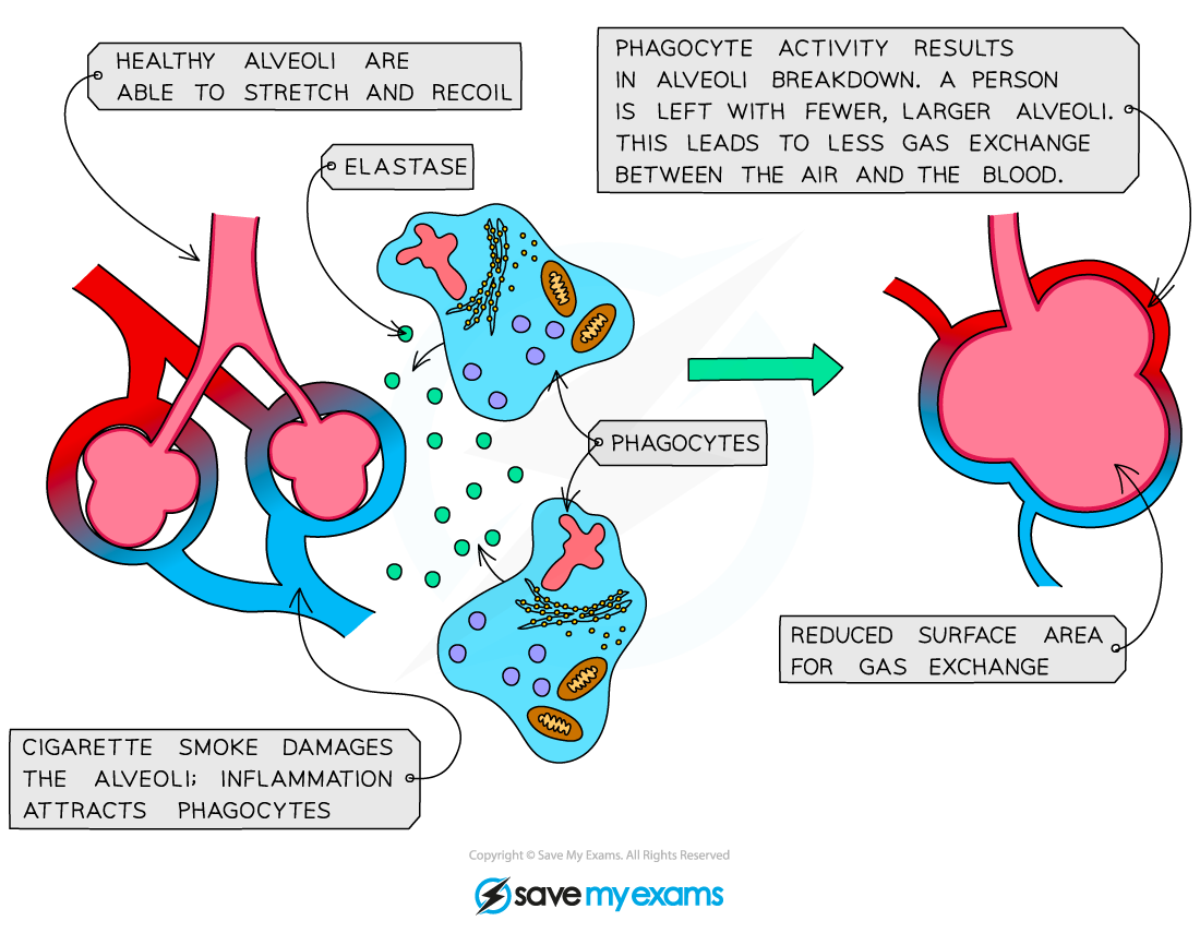 Emphysema-in-the-lungs