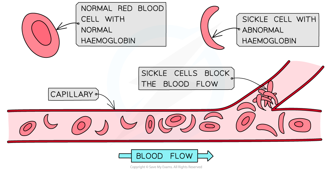 Sickle-and-Normal-red-blood-cells