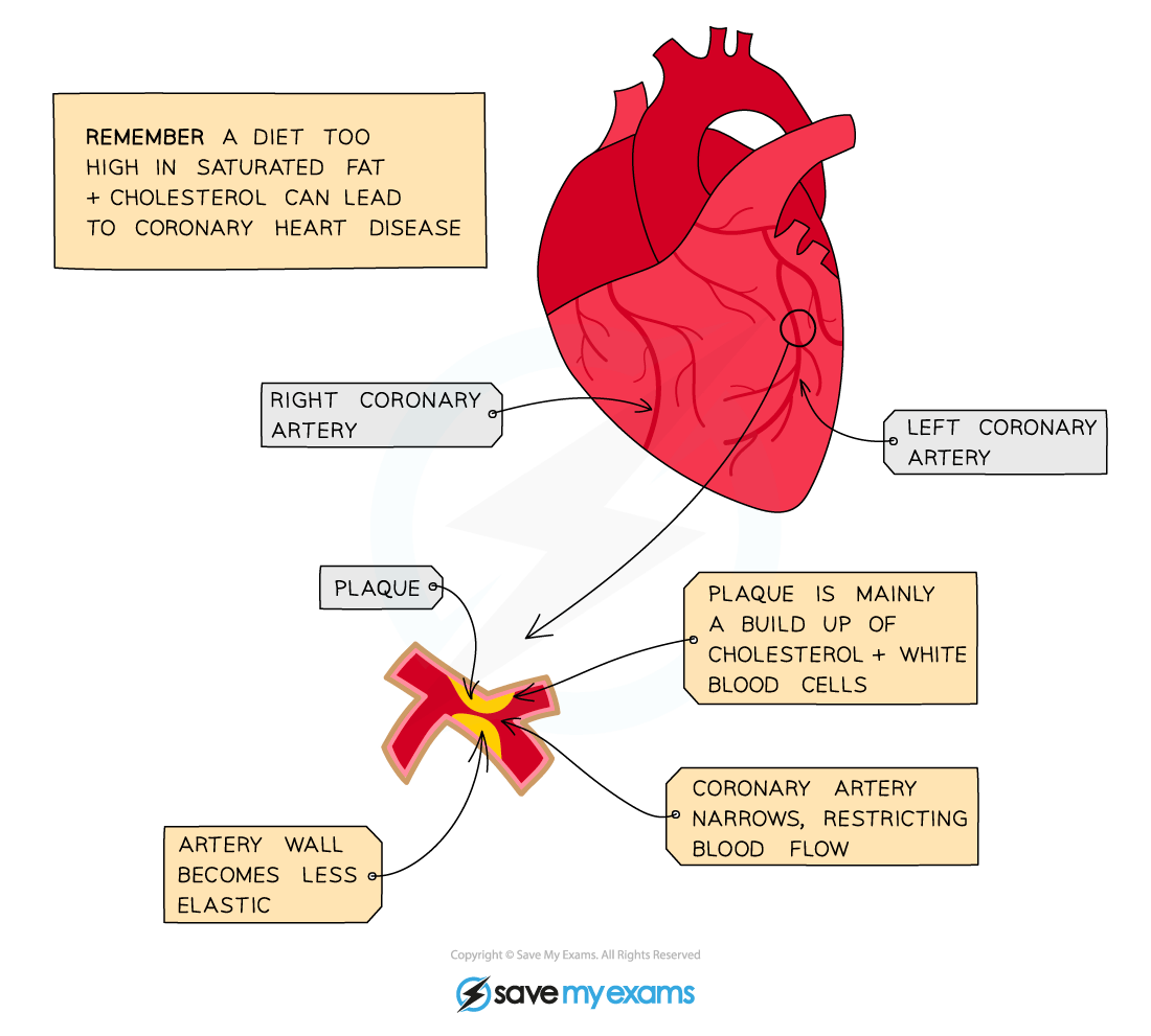 Buildup-of-plaque-in-the-coronary-arteries